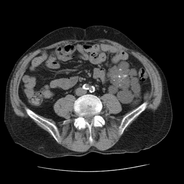 Autosomal dominant polycystic kidney disease (Radiopaedia 27851-28094 Axial non-contrast 84).jpg