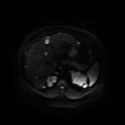 File:Autosomal dominant polycystic kidney disease (Radiopaedia 50259-55611 Axial DWI 51).jpg