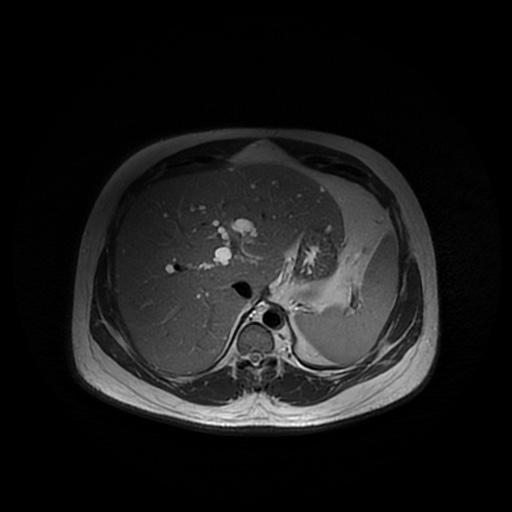 File:Autosomal dominant polycystic kidney disease (Radiopaedia 50259-55611 Axial T2 11).jpg