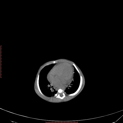 Autosomal recessive polycystic kidney disease associated with Caroli disease (Radiopaedia 61932-69984 Axial non-contrast 70).jpg