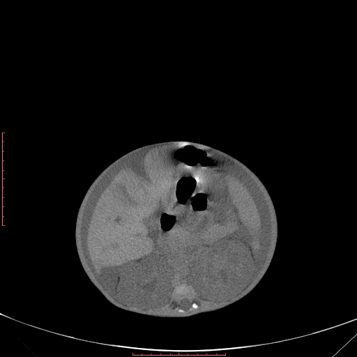 Autosomal recessive polycystic kidney disease associated with Caroli disease (Radiopaedia 61932-69984 B 186).jpg