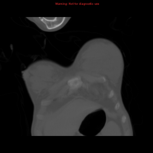 File:Avascular necrosis in sickle cell disease (Radiopaedia 17448-17152 Coronal bone window 11).jpg
