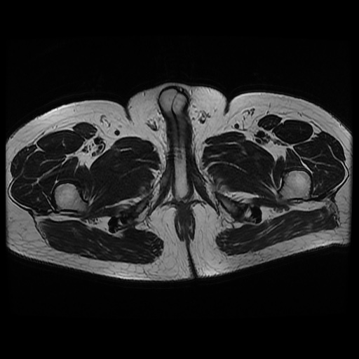 File:Avascular necrosis of the hip (Radiopaedia 61503-69465 T2 28).jpg