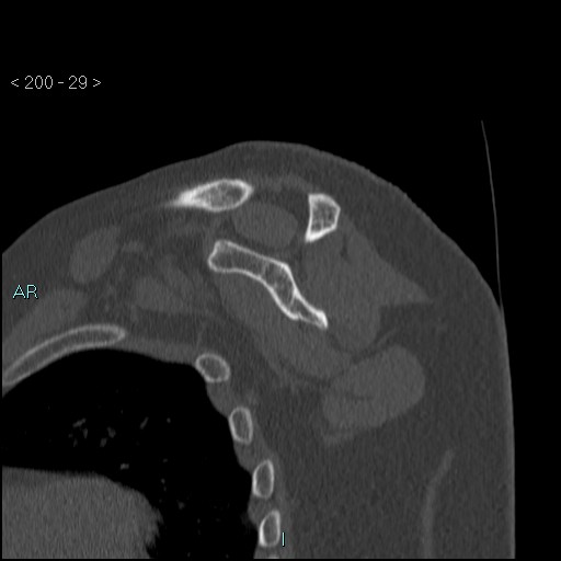 Avascular necrosis of the shoulder - Cruess stage I (Radiopaedia 77674-89887 Sagittal bone window 28).jpg