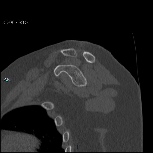 Avascular necrosis of the shoulder - Cruess stage I (Radiopaedia 77674-89887 Sagittal bone window 38).jpg