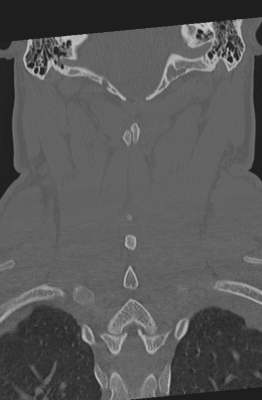 Axis peg fracture (type 3) and atlas lateral mass (type 4) fracture (Radiopaedia 37474-39324 Coronal bone window 43).png