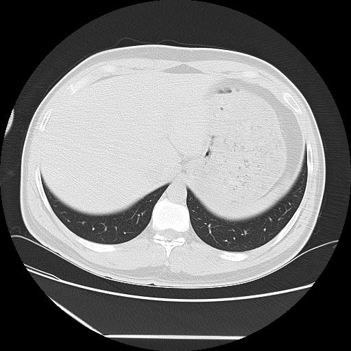 Azygos fissure (Radiopaedia 88181-104784 Axial lung window 49).jpg