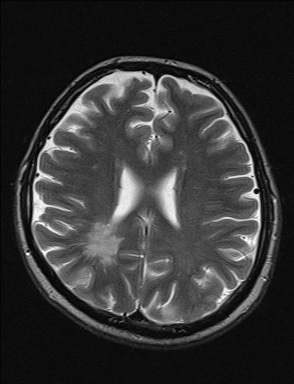 File:Balo concentric sclerosis (Radiopaedia 50458-55940 Axial T2 16).jpg