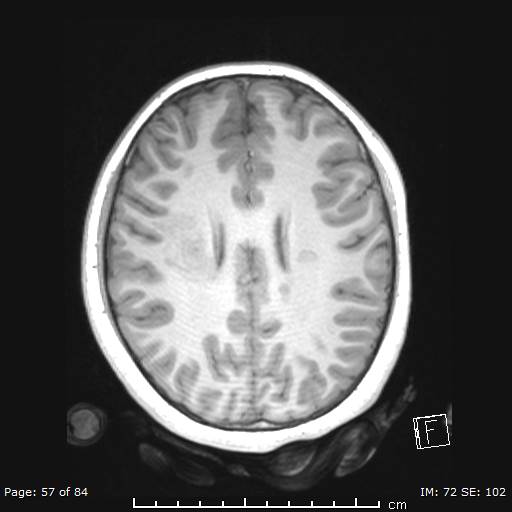 Balo concentric sclerosis (Radiopaedia 61637-69636 Axial T1 57).jpg
