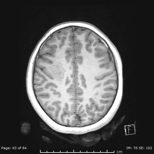 Balo concentric sclerosis (Radiopaedia 61637-69636 Axial T1 63).jpg