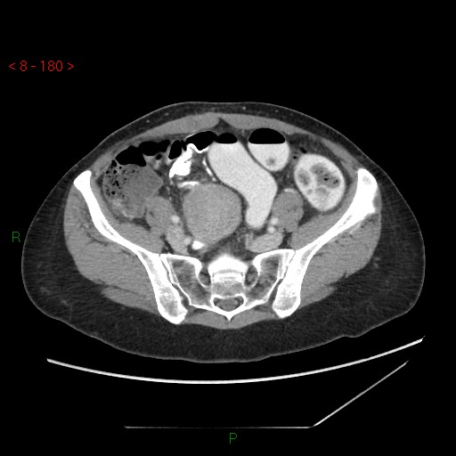Bartholin gland cyst (Radiopaedia 54904-61181 A 45).jpg