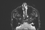 File:Basal cell carcinoma - nasal region (Radiopaedia 70292-80365 Axial DWI 12).jpg