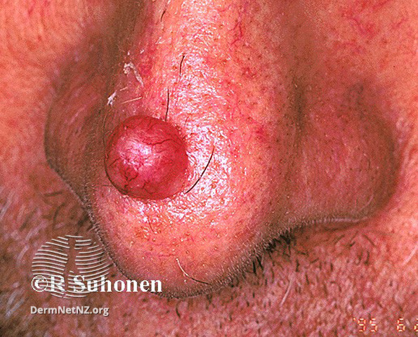 File:Basal cell carcinoma affecting the nose (DermNet NZ lesions-bcc-nose-0648).jpg