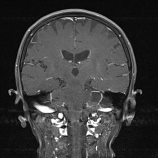 File:Base of skull chondrosarcoma (Radiopaedia 30410-31070 G 14).jpg