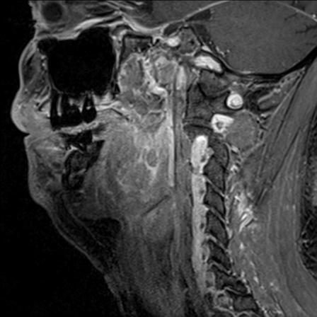 File:Base of tongue squamous cell carcinoma (Radiopaedia 31174-31884 F 63).jpg