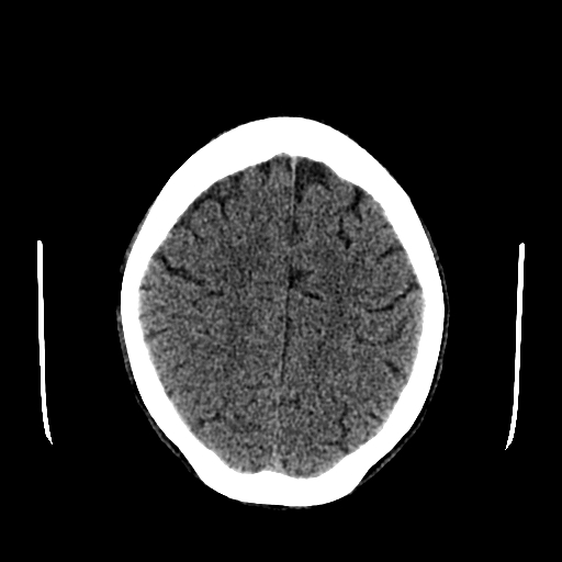 File:Basilar artery perforator aneurysm (Radiopaedia 82455-96597 Axial non-contrast 26).jpg