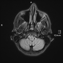 File:Basilar artery perforator aneurysm (Radiopaedia 82455-99523 Axial FLAIR 4).jpg