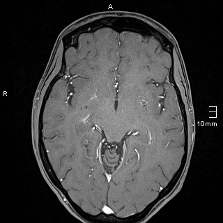 Basilar artery perforator aneurysm (Radiopaedia 82455-99523 G 67).jpg