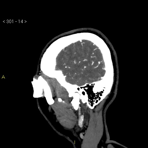 Basilar artery thrombosis (Radiopaedia 16260-15944 C 8).jpg