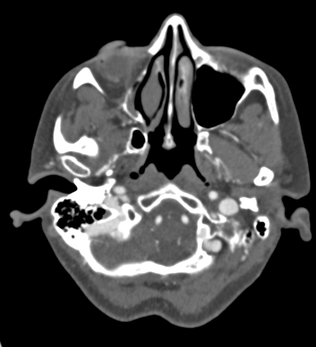 Basilar tip aneurysm with coiling (Radiopaedia 53912-60086 A 23).jpg