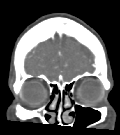File:Basilar tip aneurysm with coiling (Radiopaedia 53912-60086 B 14).jpg