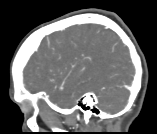 File:Basilar tip aneurysm with coiling (Radiopaedia 53912-60086 C 105).jpg