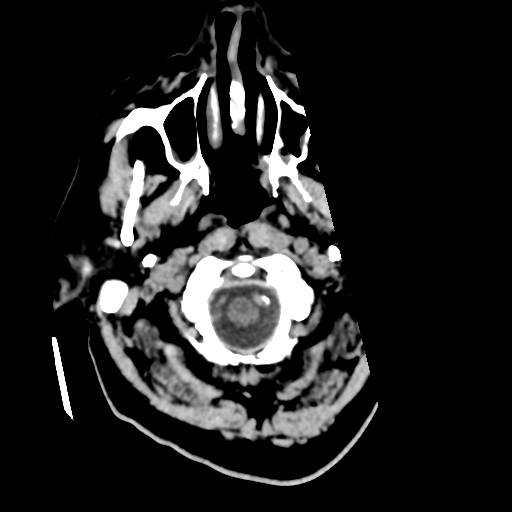 Basilar tip thrombus with endovascular clot retrieval (Radiopaedia 46320-50725 Axial non-contrast 6).png