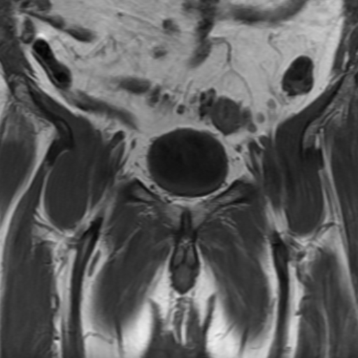 File:Benign prostatic nodular hyperplasia (Radiopaedia 16917-16634 Coronal T1 5).jpg