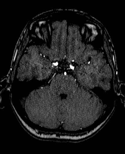 Berry aneurysm of the terminal internal carotid artery (Radiopaedia 88286-104918 Axial TOF 89).jpg