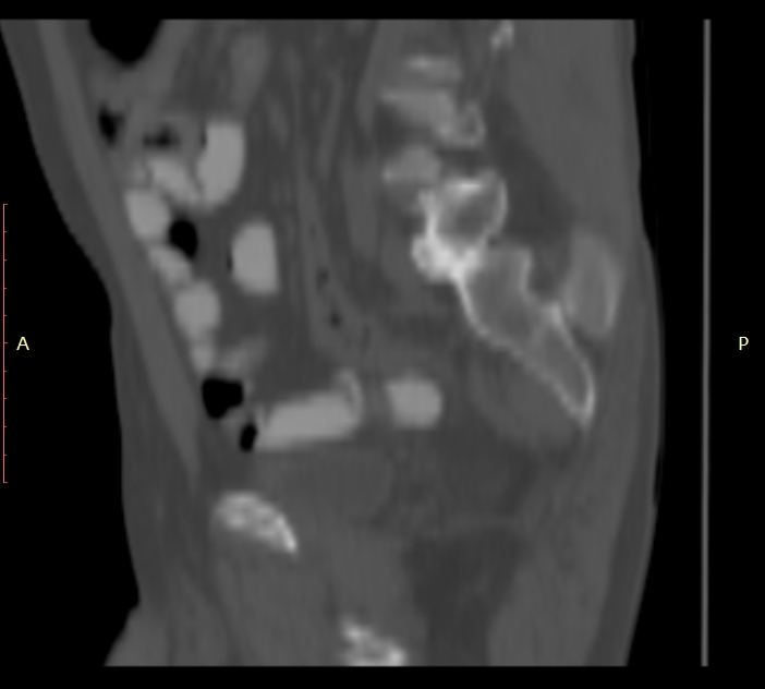Bertolotti syndrome (Radiopaedia 58974-66235 Sagittal bone window 42).jpg