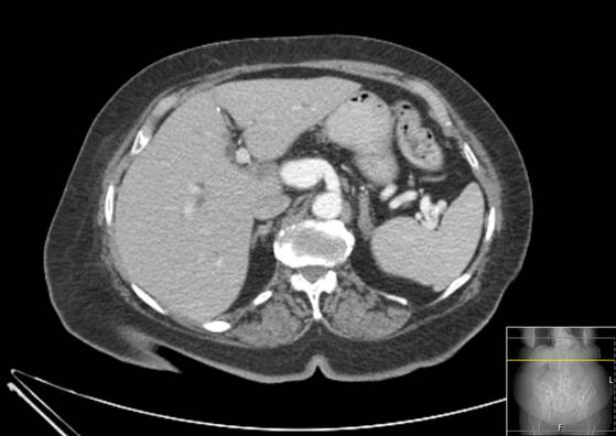 Bicameral celiacomesenteric aneurysm (Radiopaedia 55766-62327 A 15).jpg