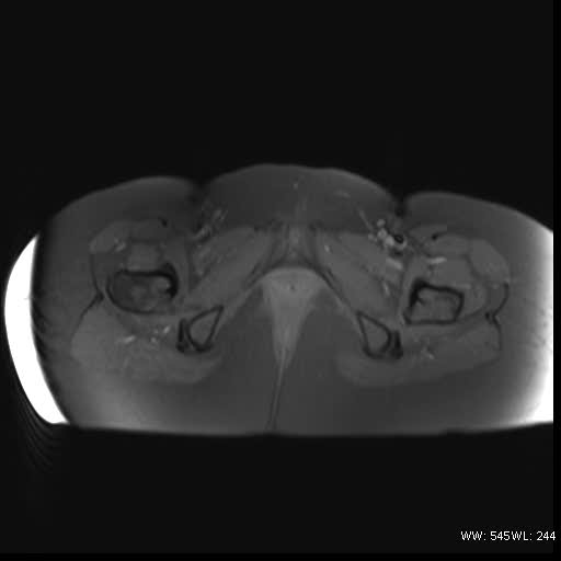 File:Bicornuate uterus- on MRI (Radiopaedia 49206-54297 Axial T1 fat sat 20).jpg