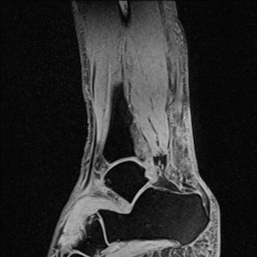 Bilateral Achilles tendon complete tear (Radiopaedia 81344-95051 Sagittal WE - Right 40).jpg