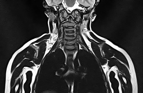 File:Bilateral Sprengel deformity with Klippel-Feil syndrome (Radiopaedia 66395-75650 Coronal T2 13).jpg