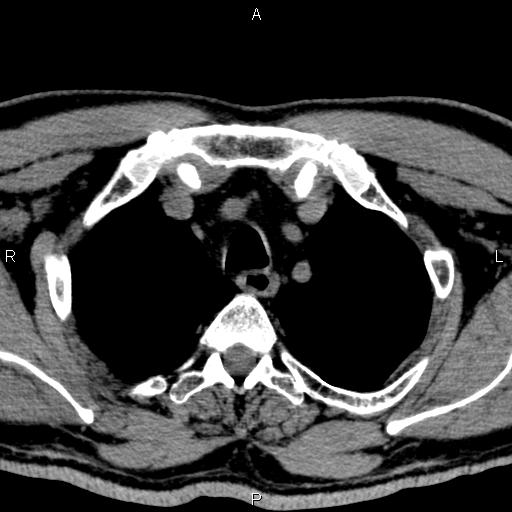 Bilateral Warthin tumors (Radiopaedia 84034-99263 Axial non-contrast 67).jpg