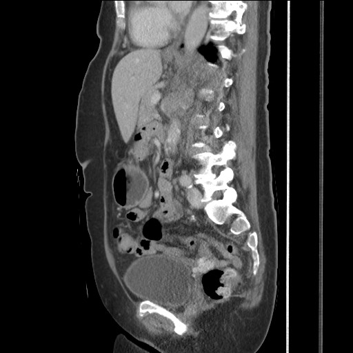 Bilateral adrenal granulocytic sarcomas (chloromas) (Radiopaedia 78375-91007 C 81).jpg