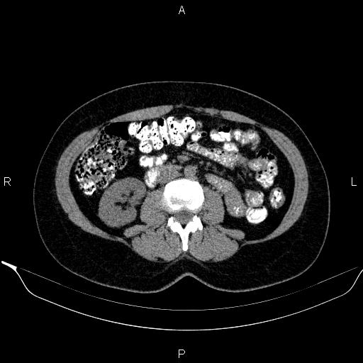 Bilateral adrenal myelolipoma (Radiopaedia 63058-71535 Axial non-contrast 89).jpg