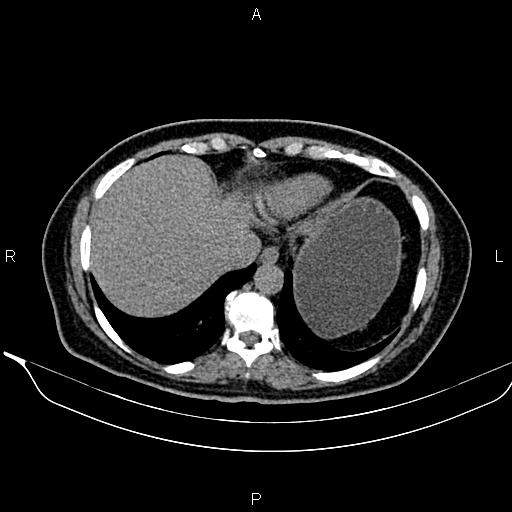 Bilateral benign adrenal adenomas (Radiopaedia 86912-103124 Axial non-contrast 19).jpg