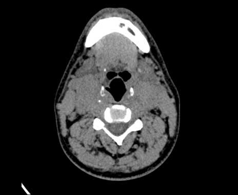 Bilateral carotid body tumors (Radiopaedia 61841-69870 Axial non-contrast 51).jpg