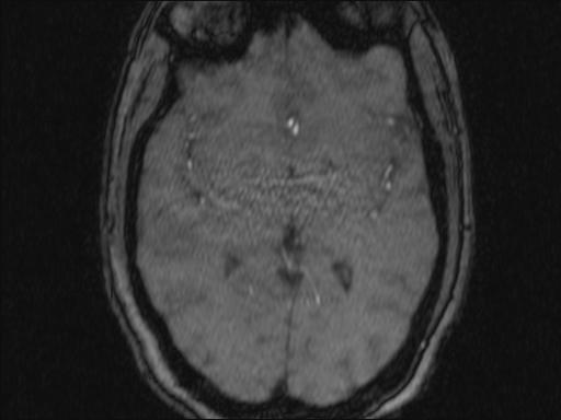 Bilateral carotid body tumors and right glomus jugulare tumor (Radiopaedia 20024-20060 Axial MRA 348).jpg
