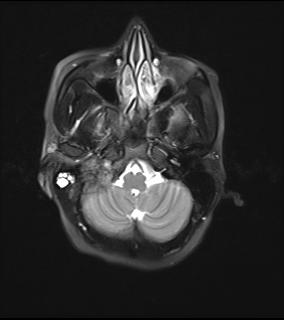 File:Bilateral carotid body tumors and right jugular paraganglioma (Radiopaedia 20024-20060 Axial 26).jpg
