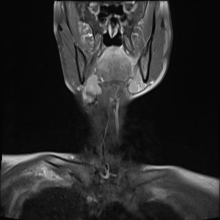 File:Bilateral carotid body tumors and right jugular paraganglioma (Radiopaedia 20024-20060 None 9).jpg