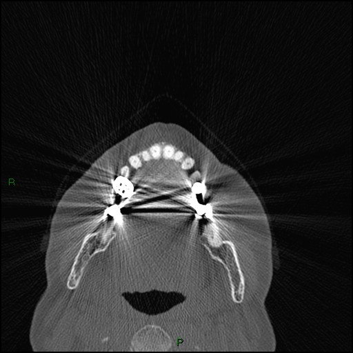 Bilateral frontal mucoceles (Radiopaedia 82352-96454 Axial bone window 274).jpg