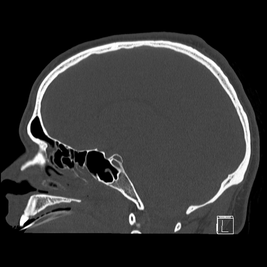 Bilateral occipital condyle fracture (type 2) (Radiopaedia 87675-104089 Sagittal bone window 62).jpg