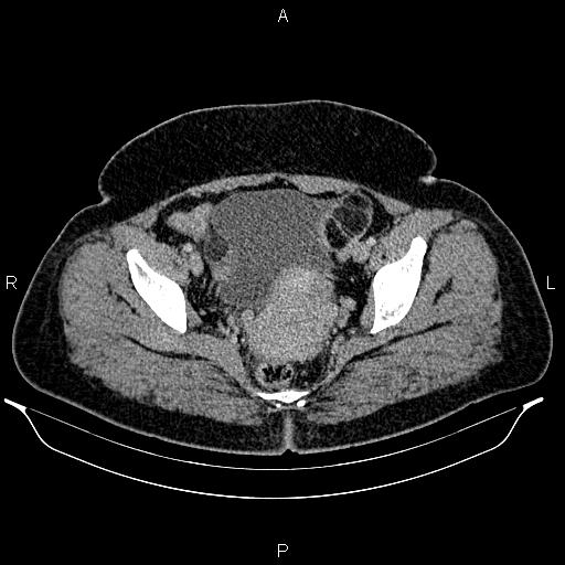 Bilateral ovarian dermoid cysts (Radiopaedia 85785-101603 A 95).jpg