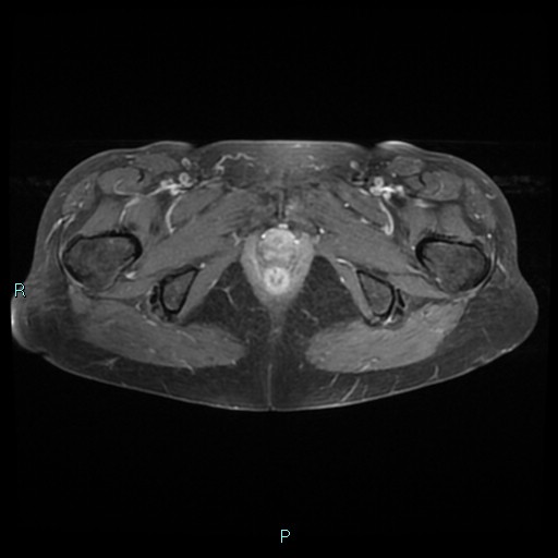 File:Bilateral ovarian fibroma (Radiopaedia 44568-48293 Axial T1 C+ fat sat 27).jpg