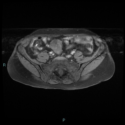 File:Bilateral ovarian fibroma (Radiopaedia 44568-48293 Axial T1 fat sat 4).jpg