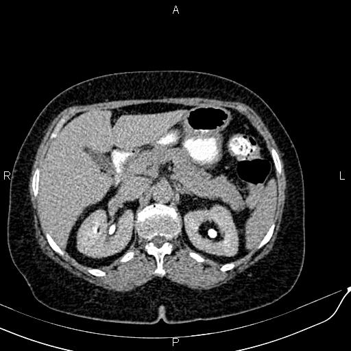 Bilateral ovarian serous cystadenocarcinoma (Radiopaedia 86062-101989 Axial C+ delayed 14).jpg