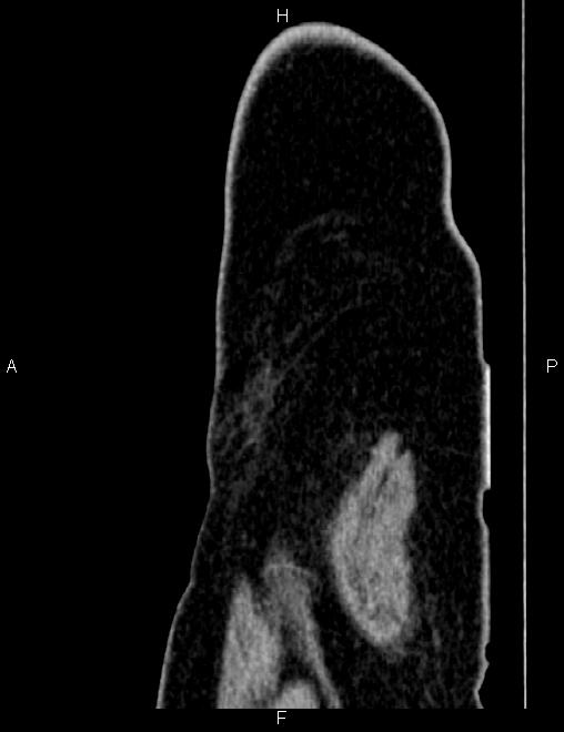 Bilateral ovarian teratoma (Radiopaedia 83131-97503 D 12).jpg