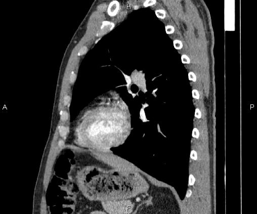 Bilateral pulmonary AVM (Radiopaedia 83134-97505 D 75).jpg